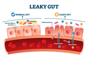 What Is A Leaky Gut?